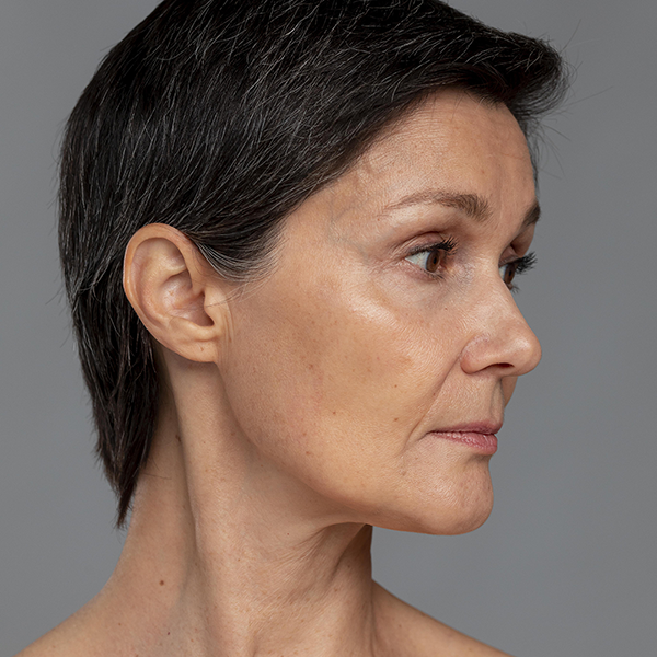 Sculptra (ácido-l-poliláctico) 